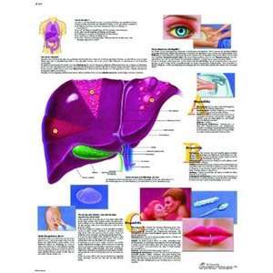  3B Scientific VR3435UU Glossy Paper Hepatitis Anatomical (Hepatits 