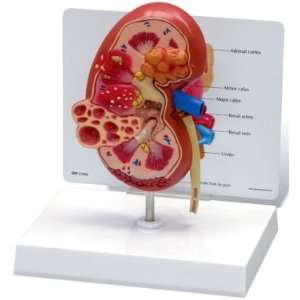 Human Diseased Kidney Anatomy/Anatomical Model #3260  