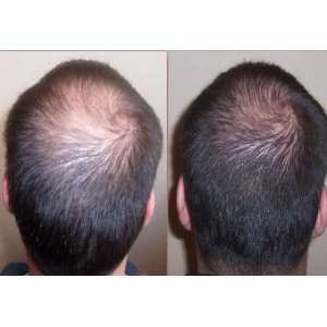  High Quality hair loss treatment (15% minoxidil + 5% 